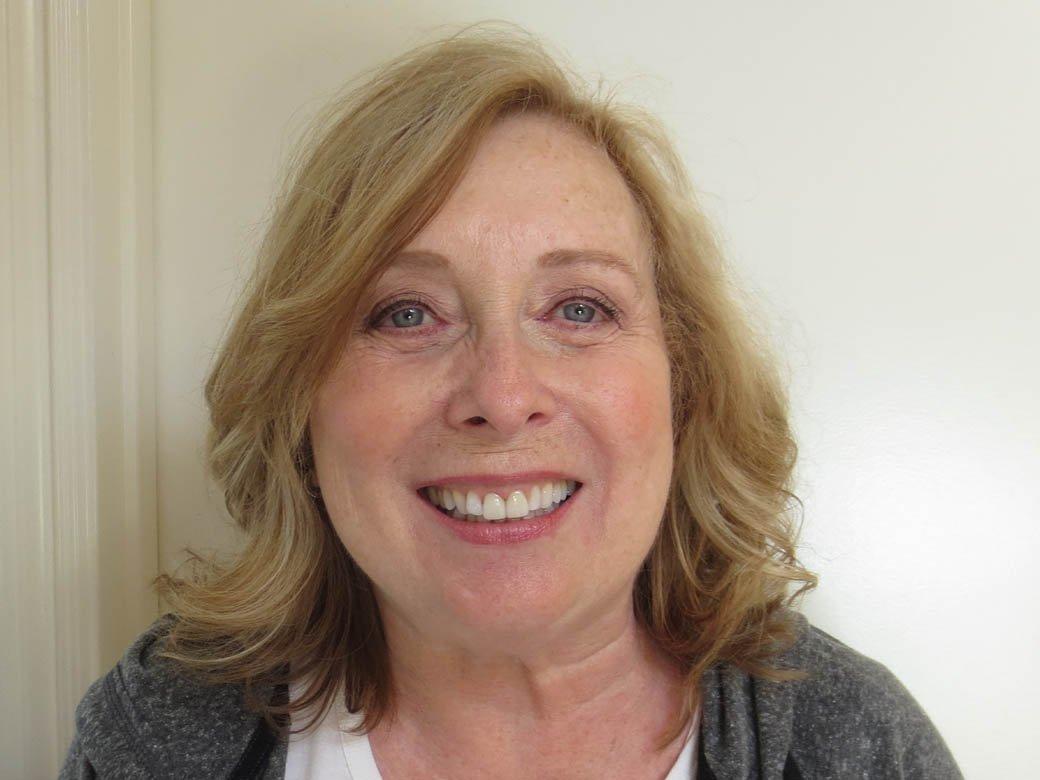 Pacific Beach Smile Studio dental crowns after — San Diego, CA