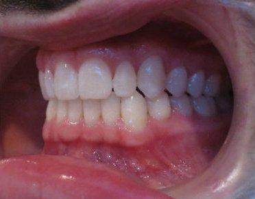 Pacific Beach Smile Studio invisalign after — San Diego, CA