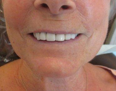 Dental Implants after at Pacific Beach Smile Studio in San Diego, CA