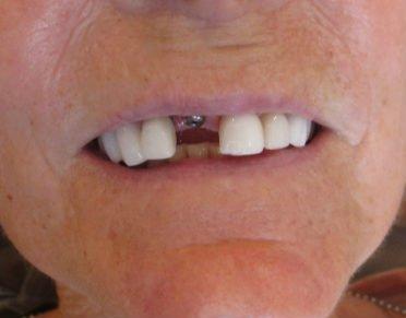 Dental Implants before at Pacific Beach Smile Studio in San Diego, CA
