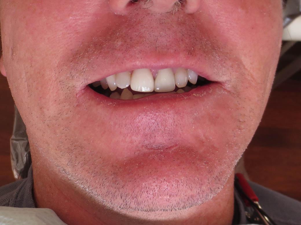 Pacific Beach Smile Studio dental crowns after — San Diego, CA