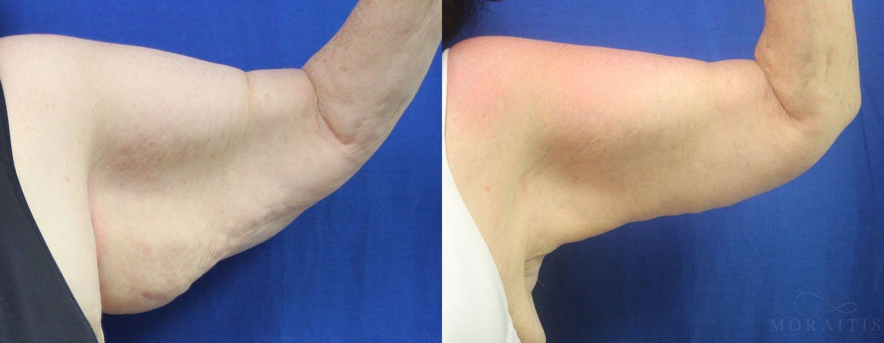 Moraitis Plastic Surgery arm lift result — Palm Harbor, FL