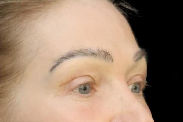 San Diego Plastic Surgery Center - Dr. Jose Rodriguez after — San Diego, CA