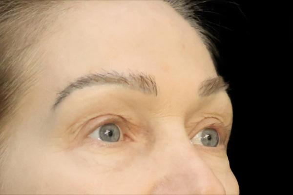 Blepharoplasty before at San Diego Plastic Surgery Center - Dr. Jose Rodriguez in San Diego, CA