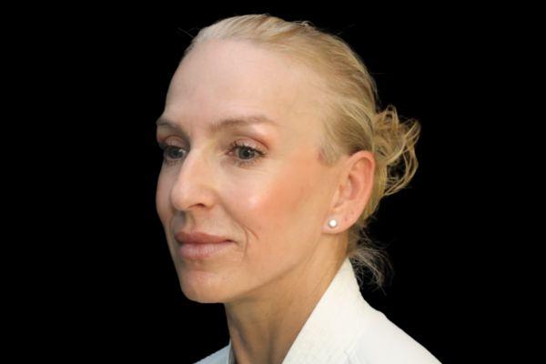 San Diego Plastic Surgery Center - Dr. Jose Rodriguez after — San Diego, CA