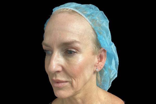 Facelift before at San Diego Plastic Surgery Center - Dr. Jose Rodriguez in San Diego, CA