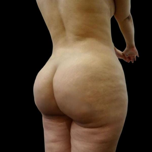 Brazilian Butt Lift after at San Diego Plastic Surgery Center - Dr. Jose Rodriguez in San Diego, CA