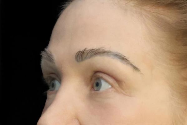 San Diego Plastic Surgery Center - Dr. Jose Rodriguez after — San Diego, CA