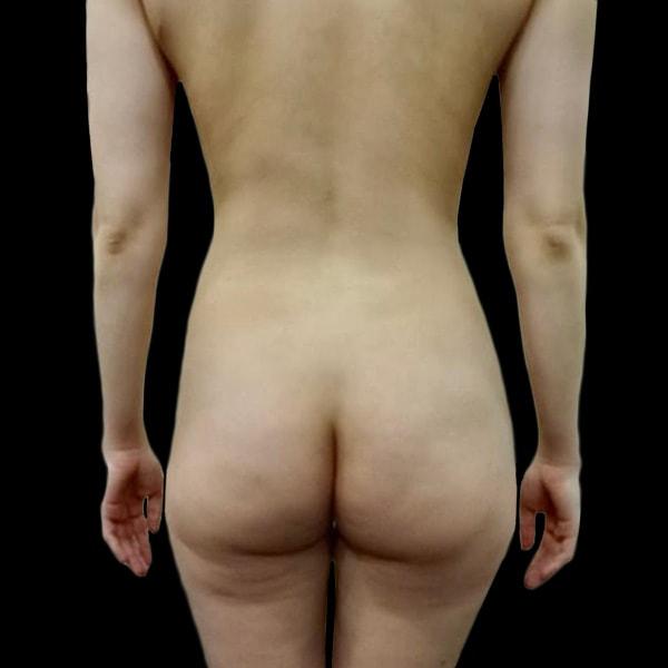 Brazilian Butt Lift before at San Diego Plastic Surgery Center - Dr. Jose Rodriguez in San Diego, CA