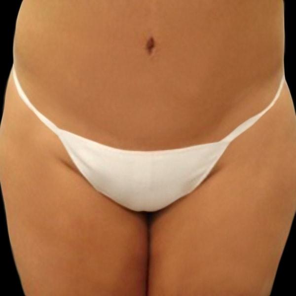 San Diego Plastic Surgery Center - Dr. Jose Rodriguez tummy tuck after — San Diego, CA