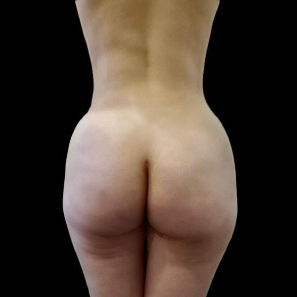 Brazilian Butt Lift after at San Diego Plastic Surgery Center - Dr. Jose Rodriguez in San Diego, CA