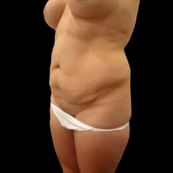 Mini Tummy Tuck before at San Diego Plastic Surgery Center - Dr. Jose Rodriguez in San Diego, CA