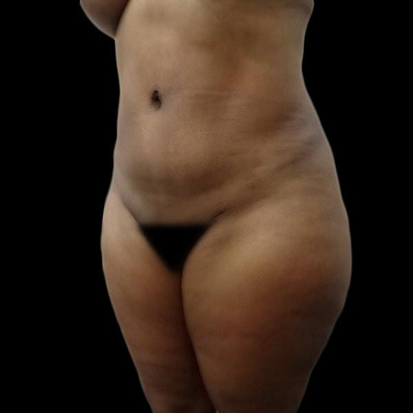 San Diego Plastic Surgery Center - Dr. Jose Rodriguez tummy tuck after — San Diego, CA