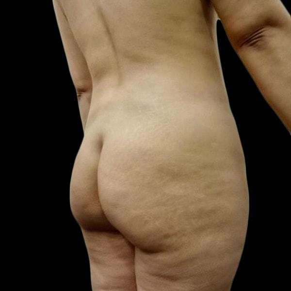 Brazilian Butt Lift before at San Diego Plastic Surgery Center - Dr. Jose Rodriguez in San Diego, CA