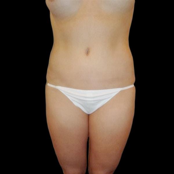 San Diego Plastic Surgery Center - Dr. Jose Rodriguez tummy tuck after — San Diego, CA