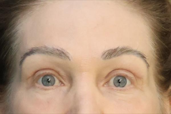San Diego Plastic Surgery Center - Dr. Jose Rodriguez after — San Diego, CA