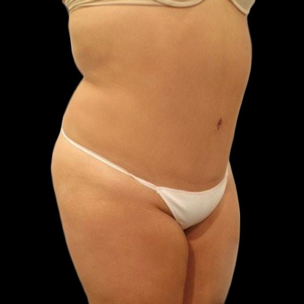 San Diego Plastic Surgery Center - Dr. Jose Rodriguez tummy tuck after — San Diego, CA