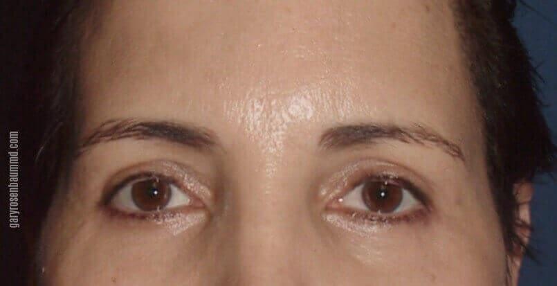 Gary J. Rosenbaum, MD eyelid lift after — Miami Beach, FL