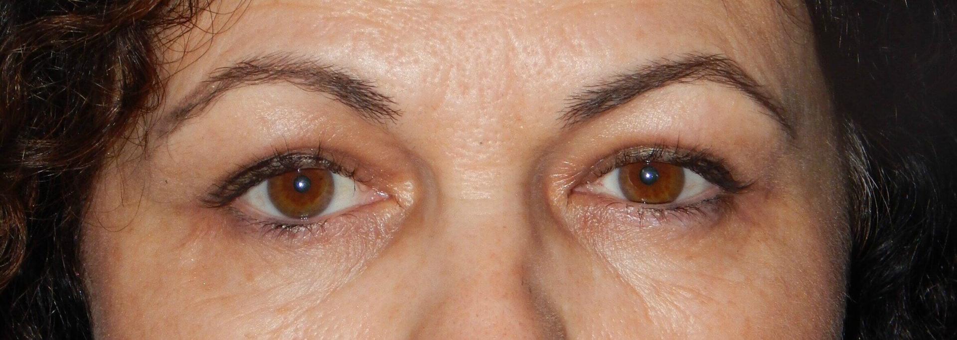 Gary J. Rosenbaum, MD eyelid lift after — Miami Beach, FL