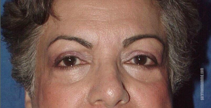 Gary J. Rosenbaum, MD eyelid lift after — Miami Beach, FL