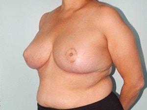 Gary J. Rosenbaum, MD breast reduction after — Miami Beach, FL