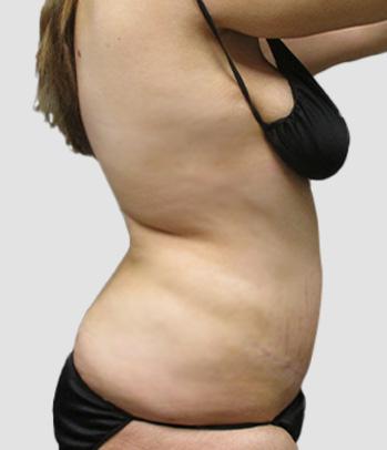 Sono Bello Portland liposuction after — Portland, OR