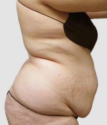 Liposuction before at Sono Bello Portland in Portland, OR
