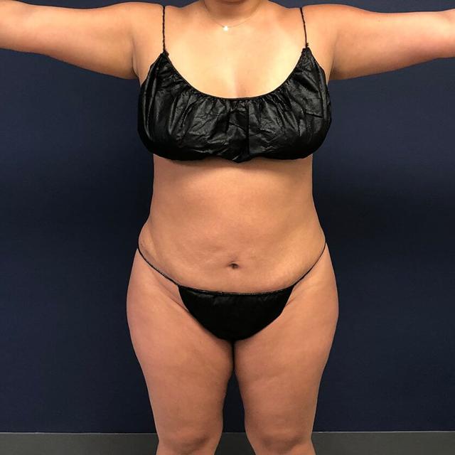 Liposuction after at Sono Bello Portland in Portland, OR