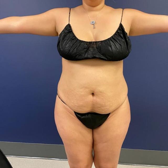 Liposuction before at Sono Bello Portland in Portland, OR