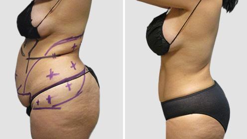 Sono Bello Portland liposuction result — Portland, OR