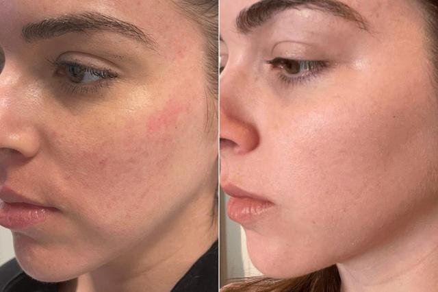 Chemical Peel result at Body+Beauty Lab in Philadelphia, PA
