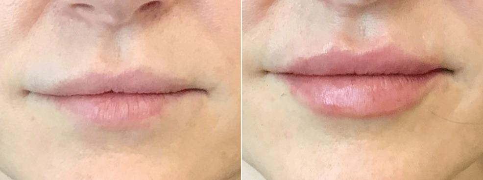 Body+Beauty Lab lip filler result — Philadelphia, PA