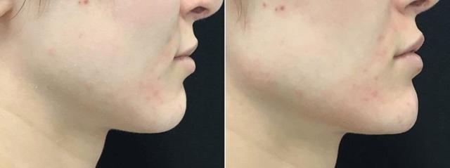 Jawline Filler result at Body+Beauty Lab in Philadelphia, PA