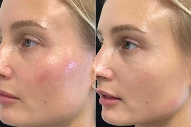 Juvederm result at Body+Beauty Lab in Philadelphia, PA
