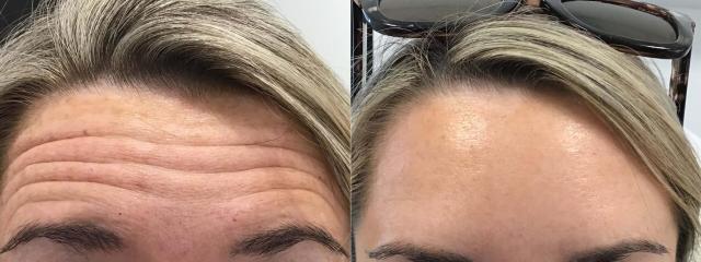 Botox result at Body+Beauty Lab in Philadelphia, PA