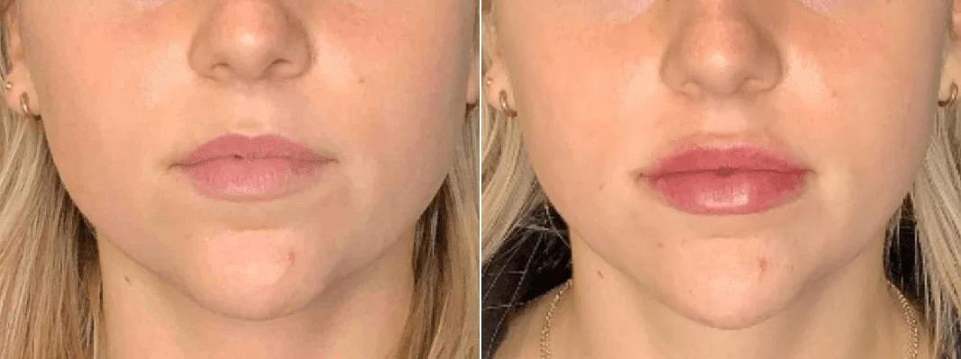 Body+Beauty Lab lip filler result — Philadelphia, PA