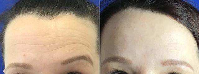 Botox result at Body+Beauty Lab in Philadelphia, PA