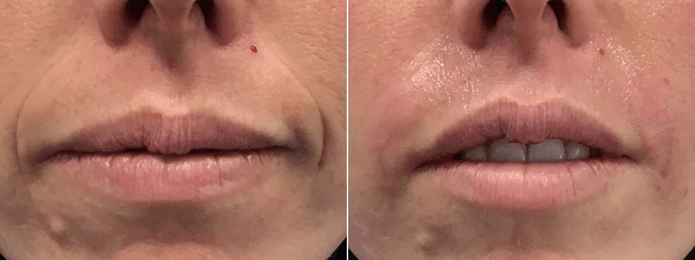 Body+Beauty Lab lip filler result — Philadelphia, PA
