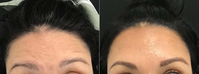 Botox result at Body+Beauty Lab in Philadelphia, PA