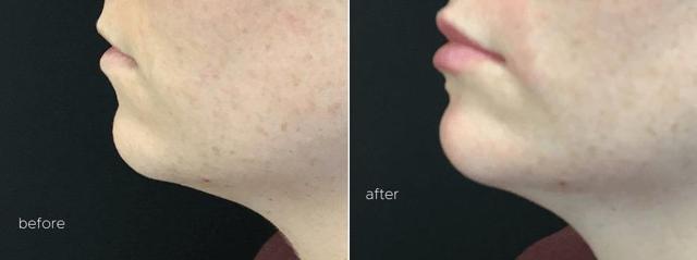 Jawline Filler result at Body+Beauty Lab in Philadelphia, PA