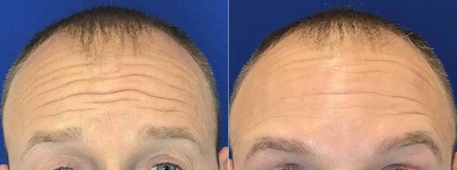Botox result at Body+Beauty Lab in Philadelphia, PA
