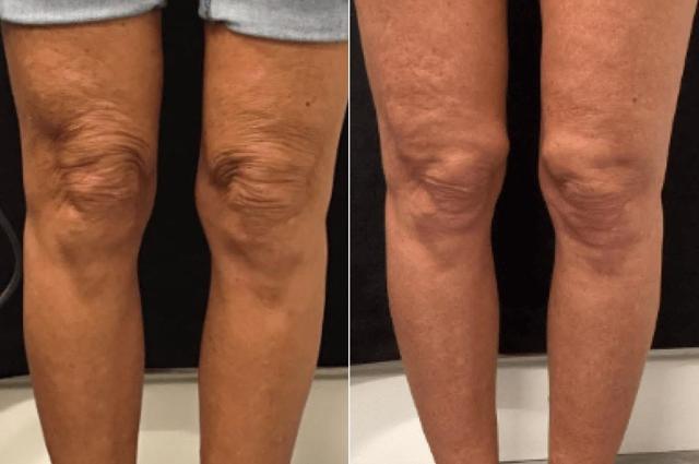 Chemical Peel result at Body+Beauty Lab in Philadelphia, PA