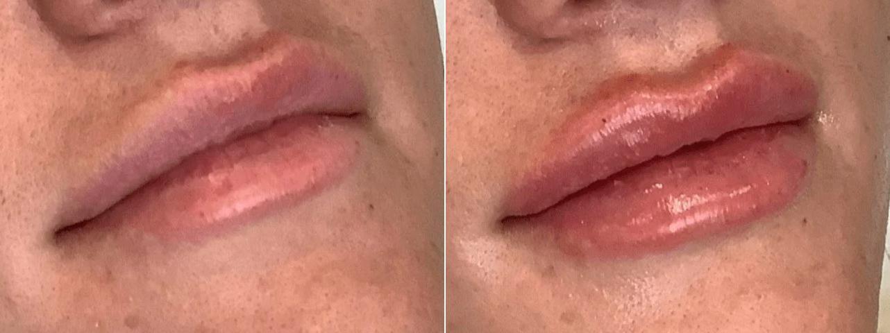 Body+Beauty Lab lip filler result — Philadelphia, PA