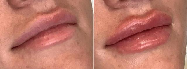 Juvederm result at Body+Beauty Lab in Philadelphia, PA