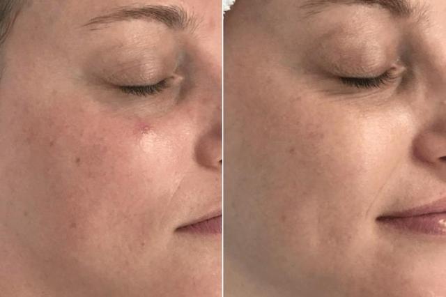 Chemical Peel result at Body+Beauty Lab in Philadelphia, PA