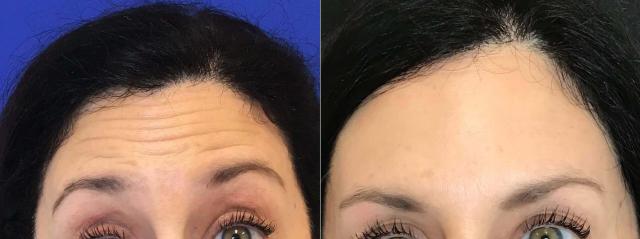Botox result at Body+Beauty Lab in Philadelphia, PA
