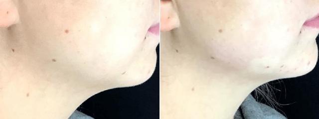 Jawline Filler result at Body+Beauty Lab in Philadelphia, PA