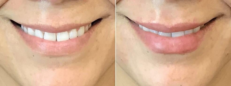 Body+Beauty Lab lip filler result — Philadelphia, PA
