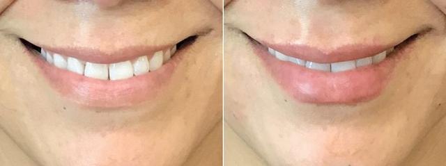 Juvederm result at Body+Beauty Lab in Philadelphia, PA