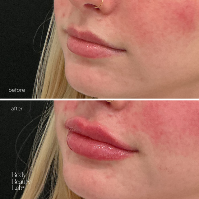 Lip Filler result at Body+Beauty Lab in Philadelphia, PA